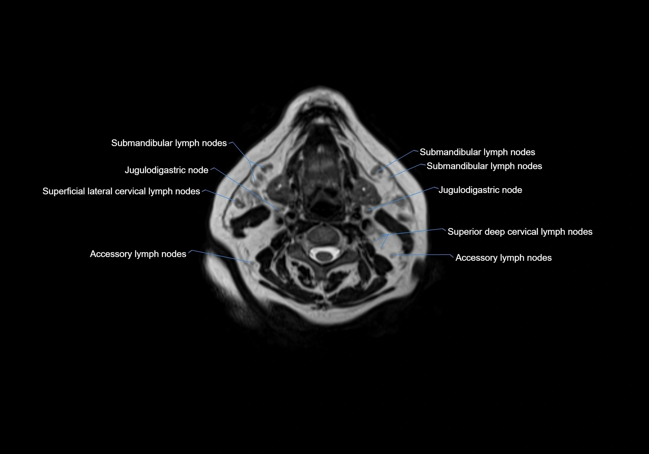 Neck axial  lymph node cross sectional MRI anatomy 3T MRI  image-img-00001-00052.webp